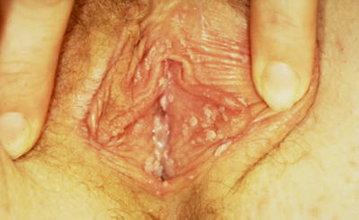 Female genital warts on the vulva