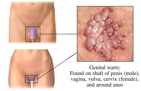 Diagram of genital warts on both male and female