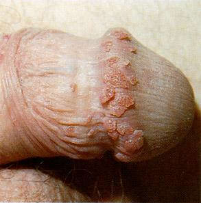 A more dry case of warts
