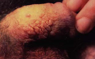 Good example of genital wart clusters on the penis