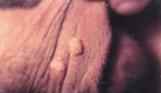 Closeup of a couple of warts on the foreskin