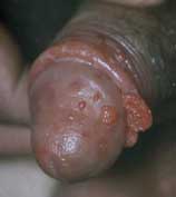 Genital warts on the head of the penis