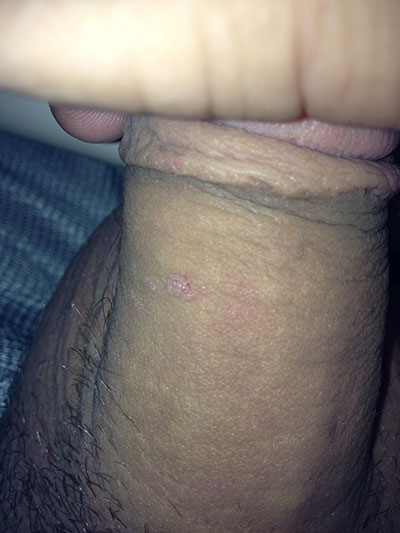 Tiny cluster of bumps on the penis shaft