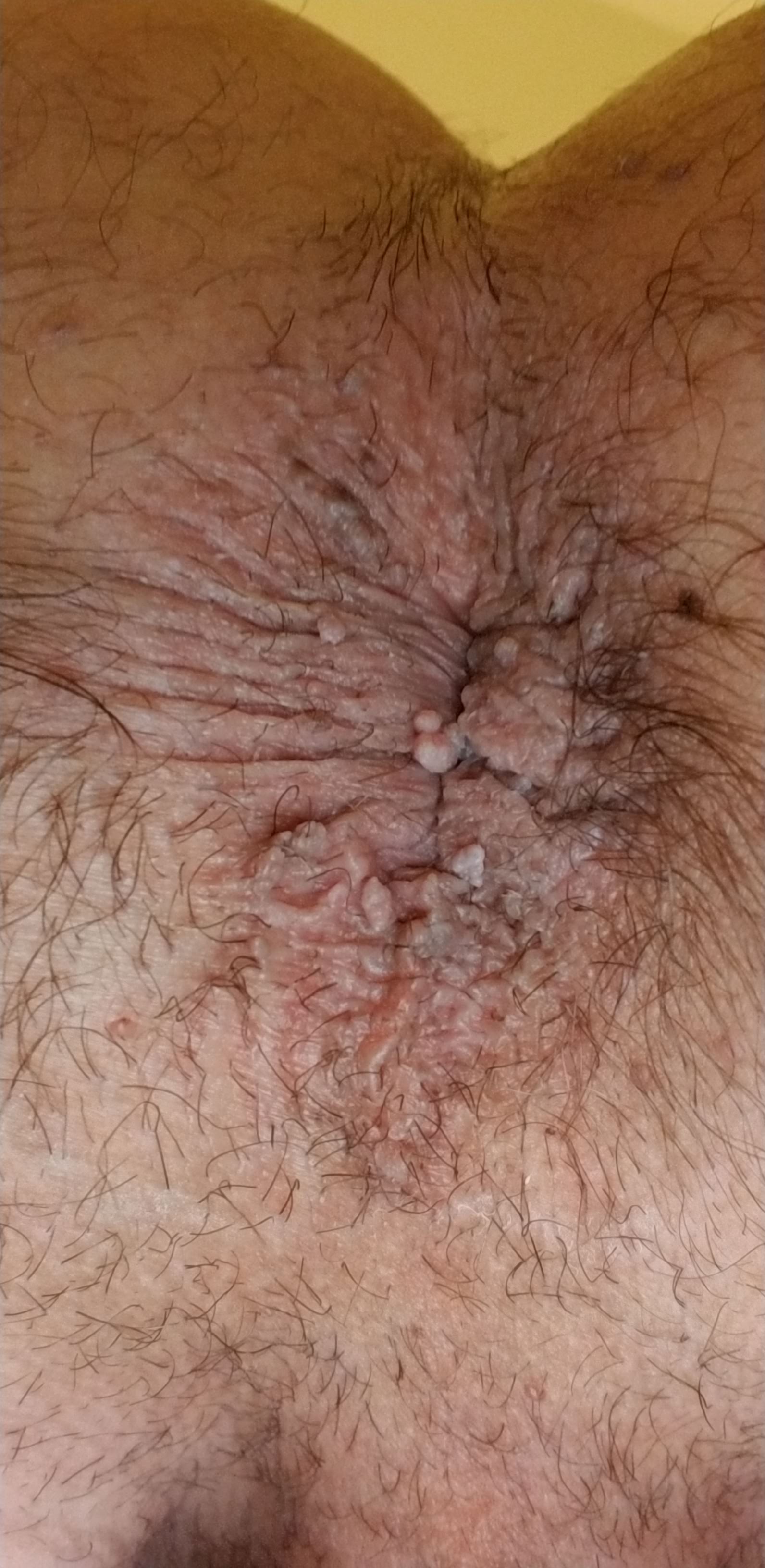 another bad case of anal warts