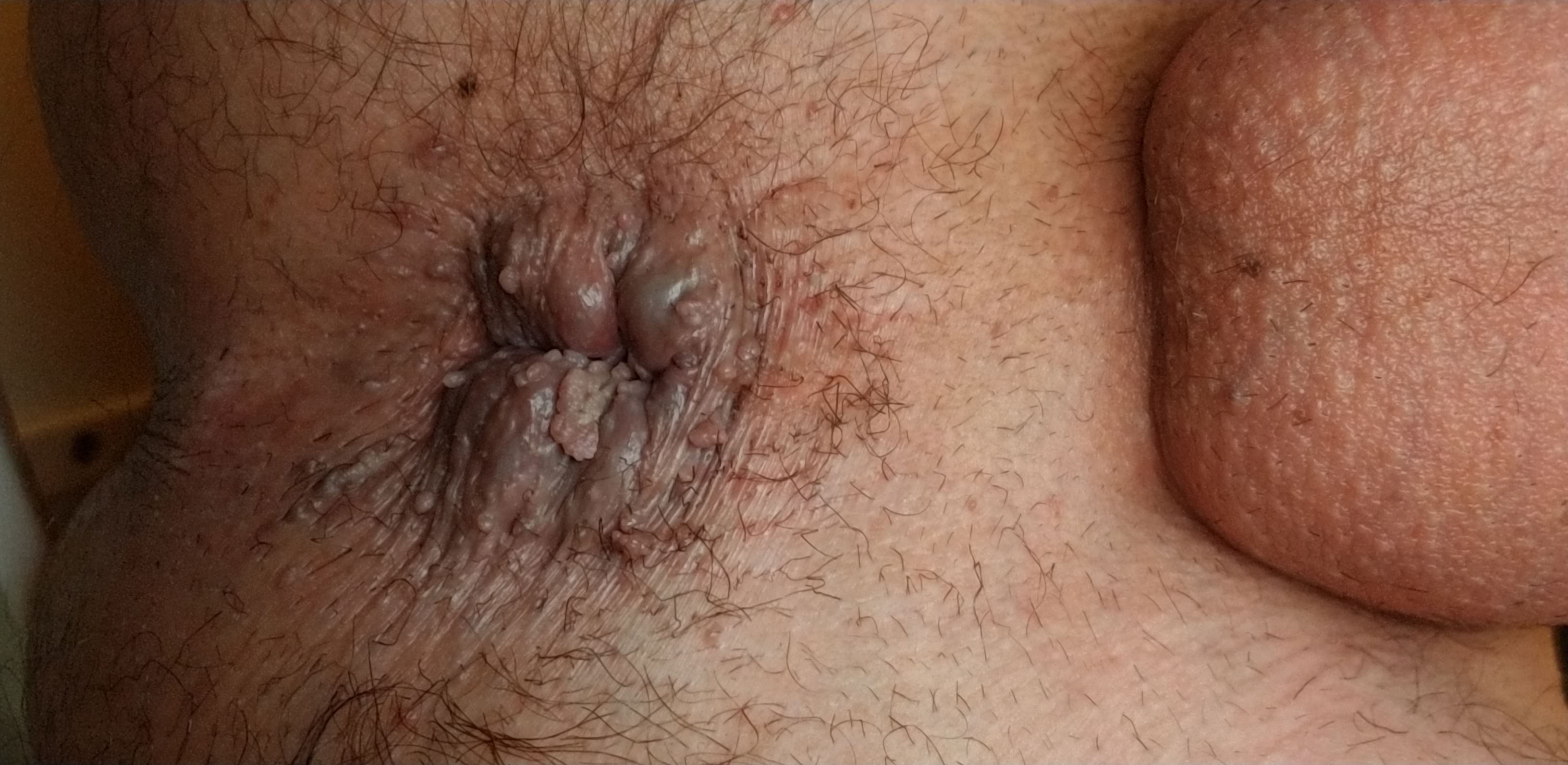 bad case of anal warts