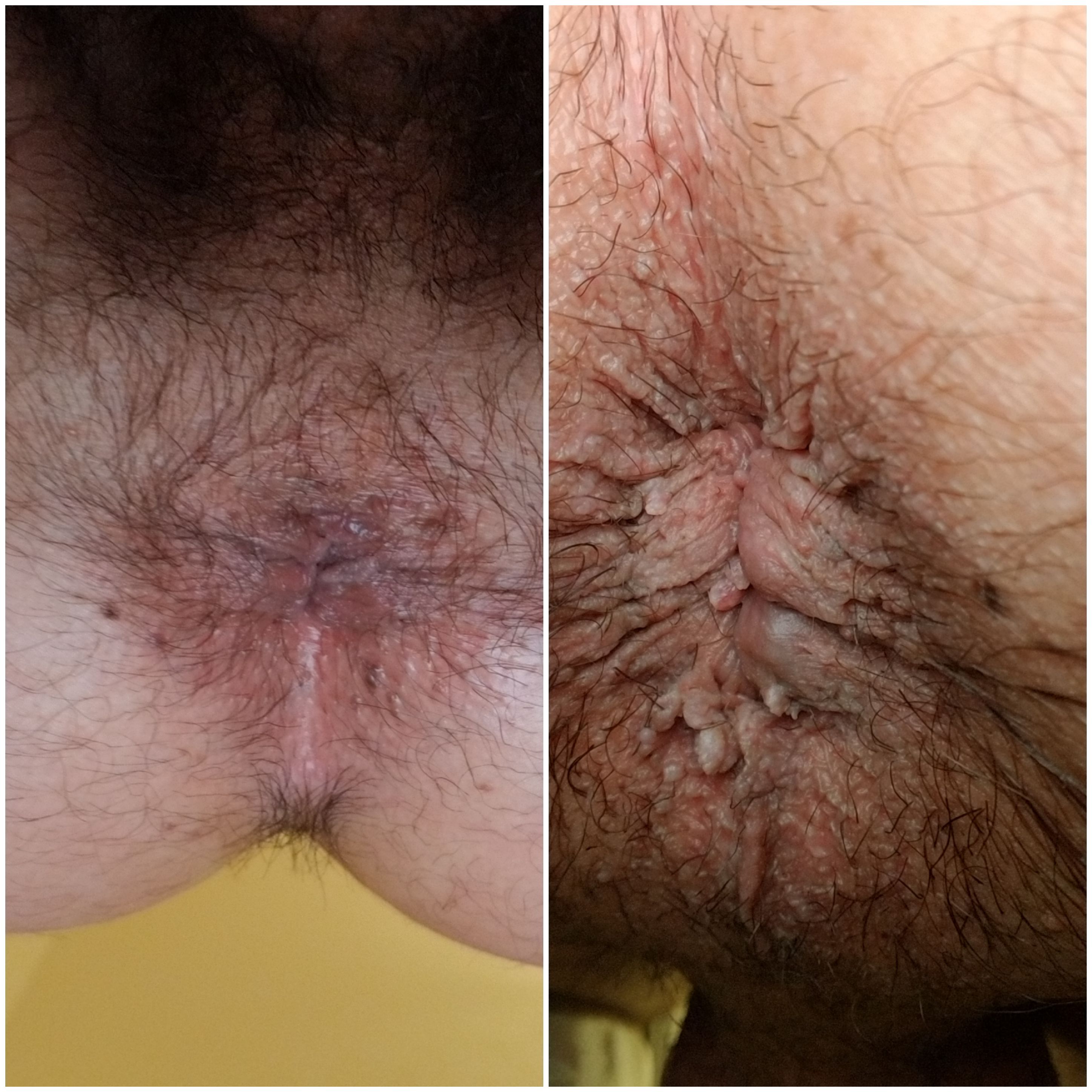before after photo of anal warts