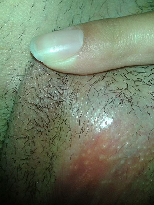 female fordyce spots