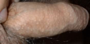 fordyce spots look like goose bumps along the penis shaft