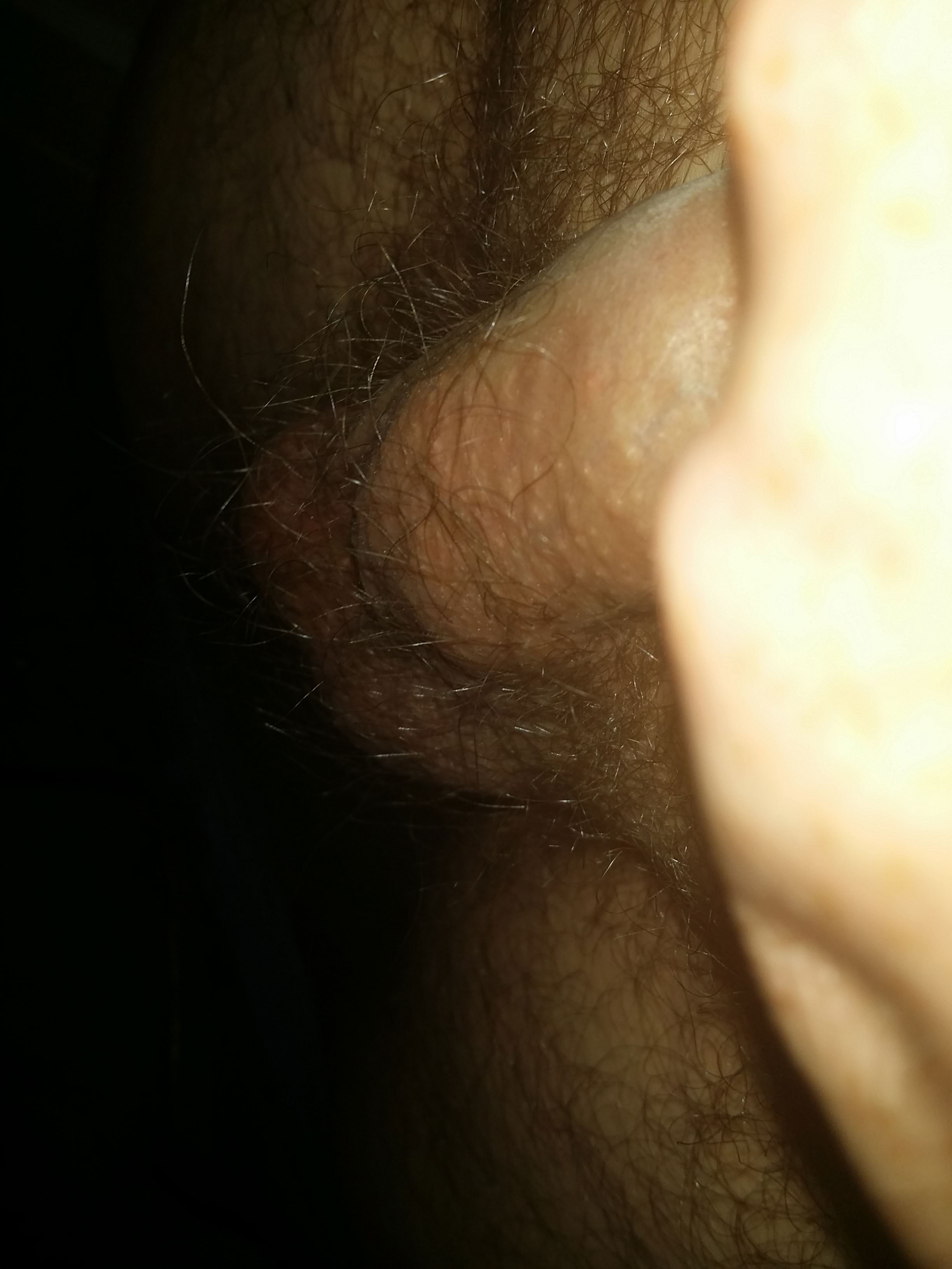 fordyce spots on the underside of the penis shaft