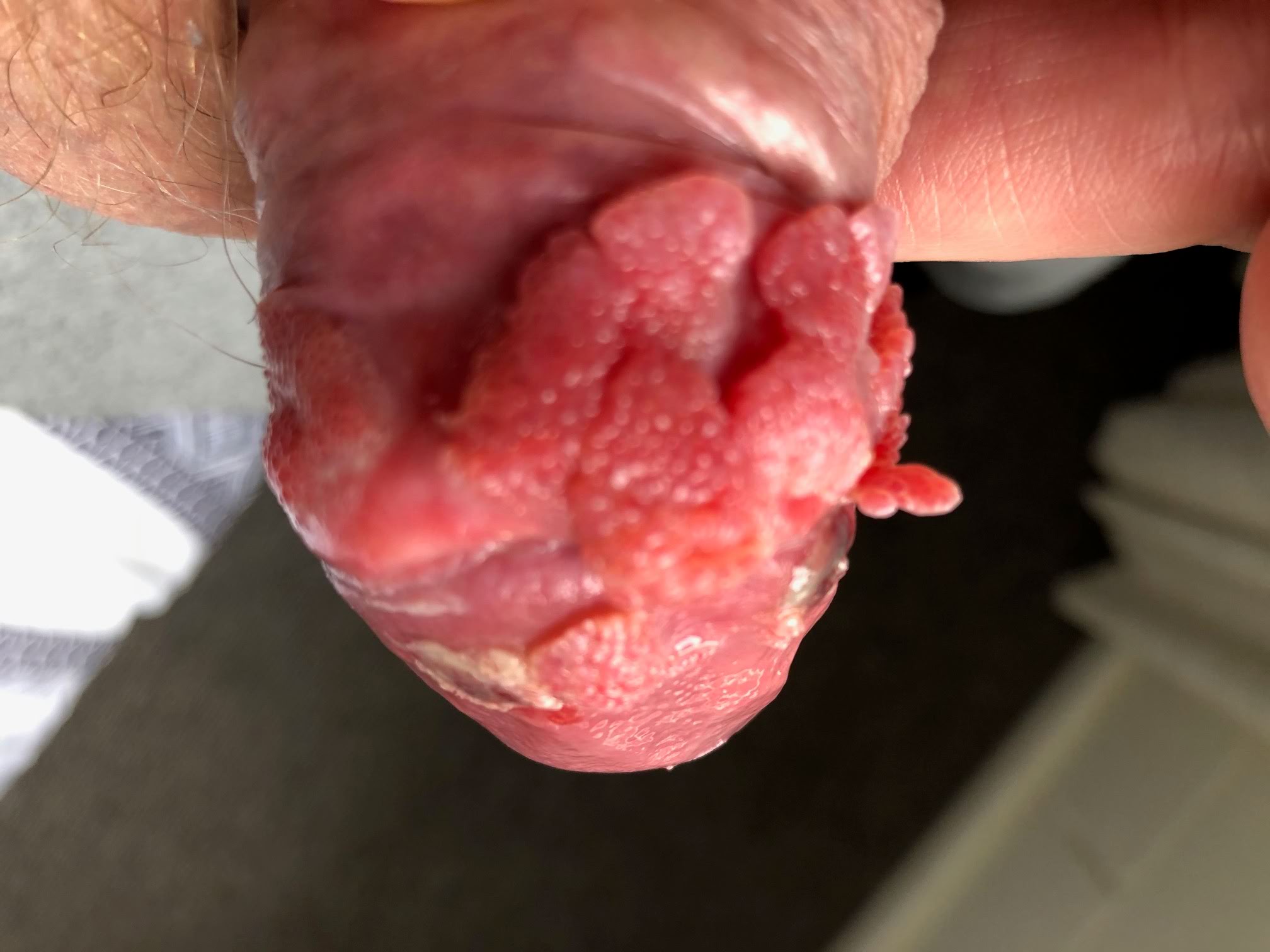 large cluster of layered genital warts