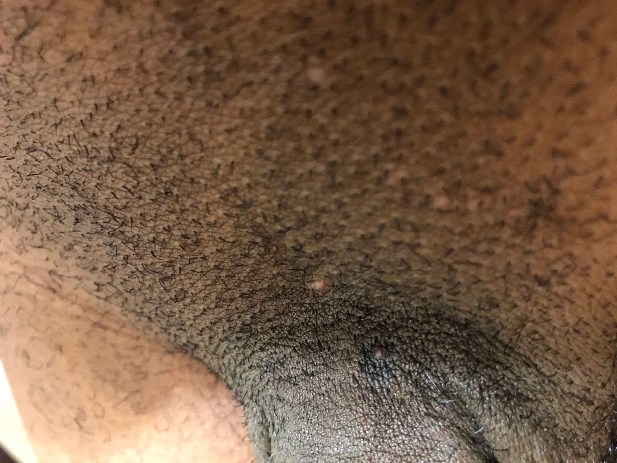sparse single warts in pubic hair region
