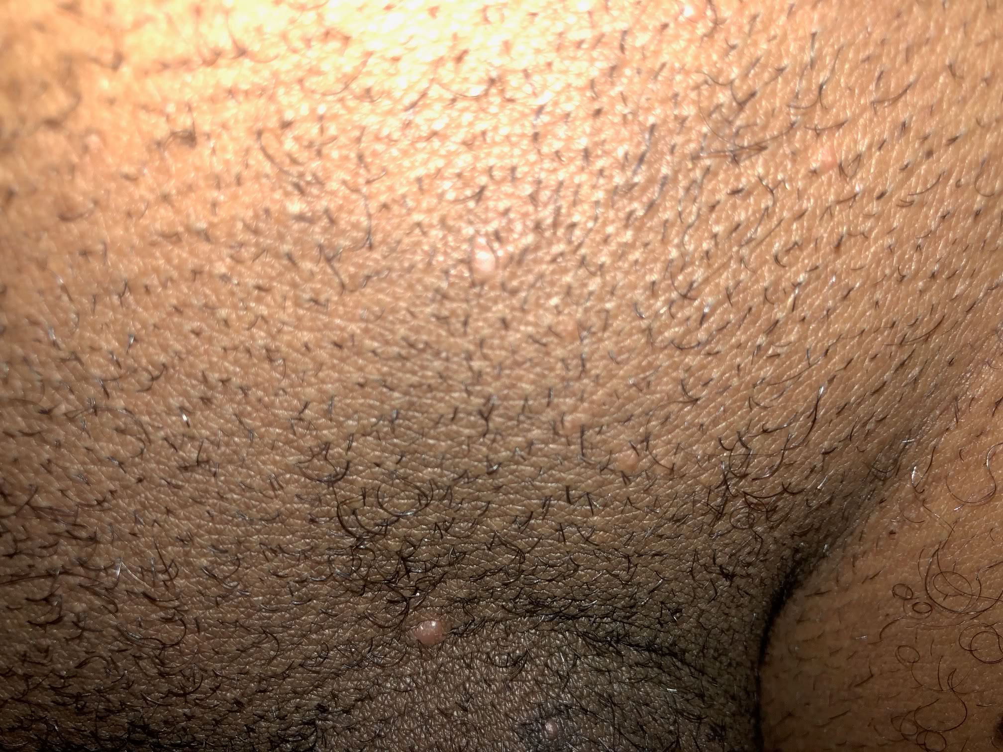 couple of small warts in the pubic hair area