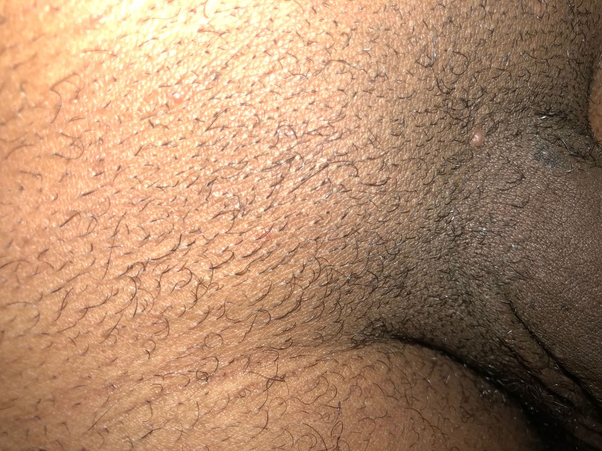 couple of small warts in the pubic hair area