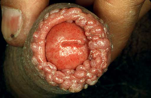 bad case of warts around the rim of the penis head