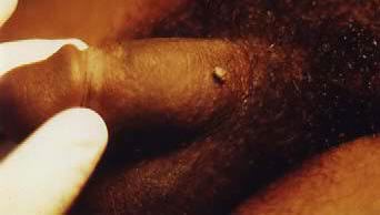 big wart on mans penis