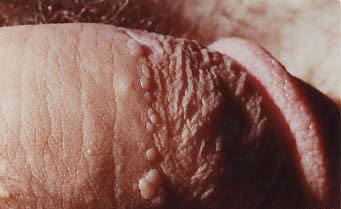 cluster ring of genital warts around foreskin