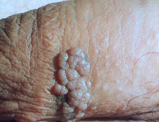 bad cluster of warts on the shaft