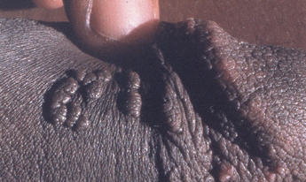 bad cluster of genital warts on a man