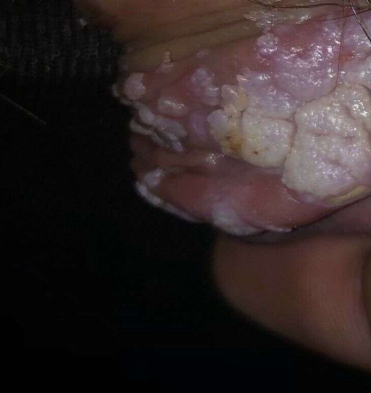 white clusters of genital warts