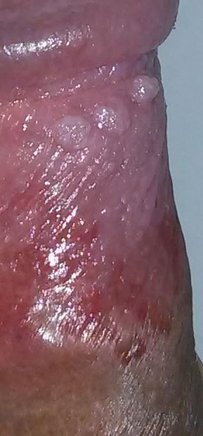 man infected with genital warts