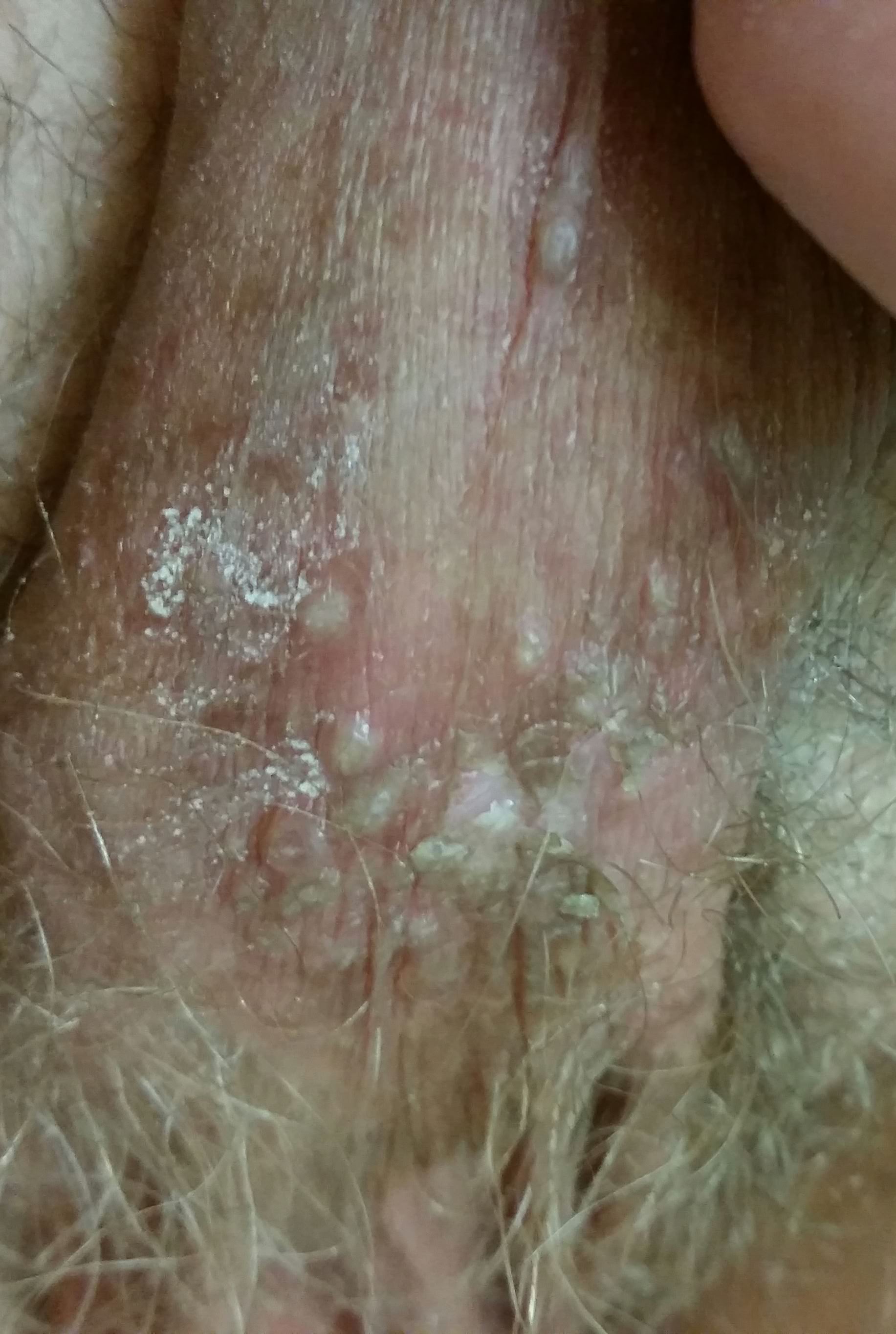 genital warts on the penis
