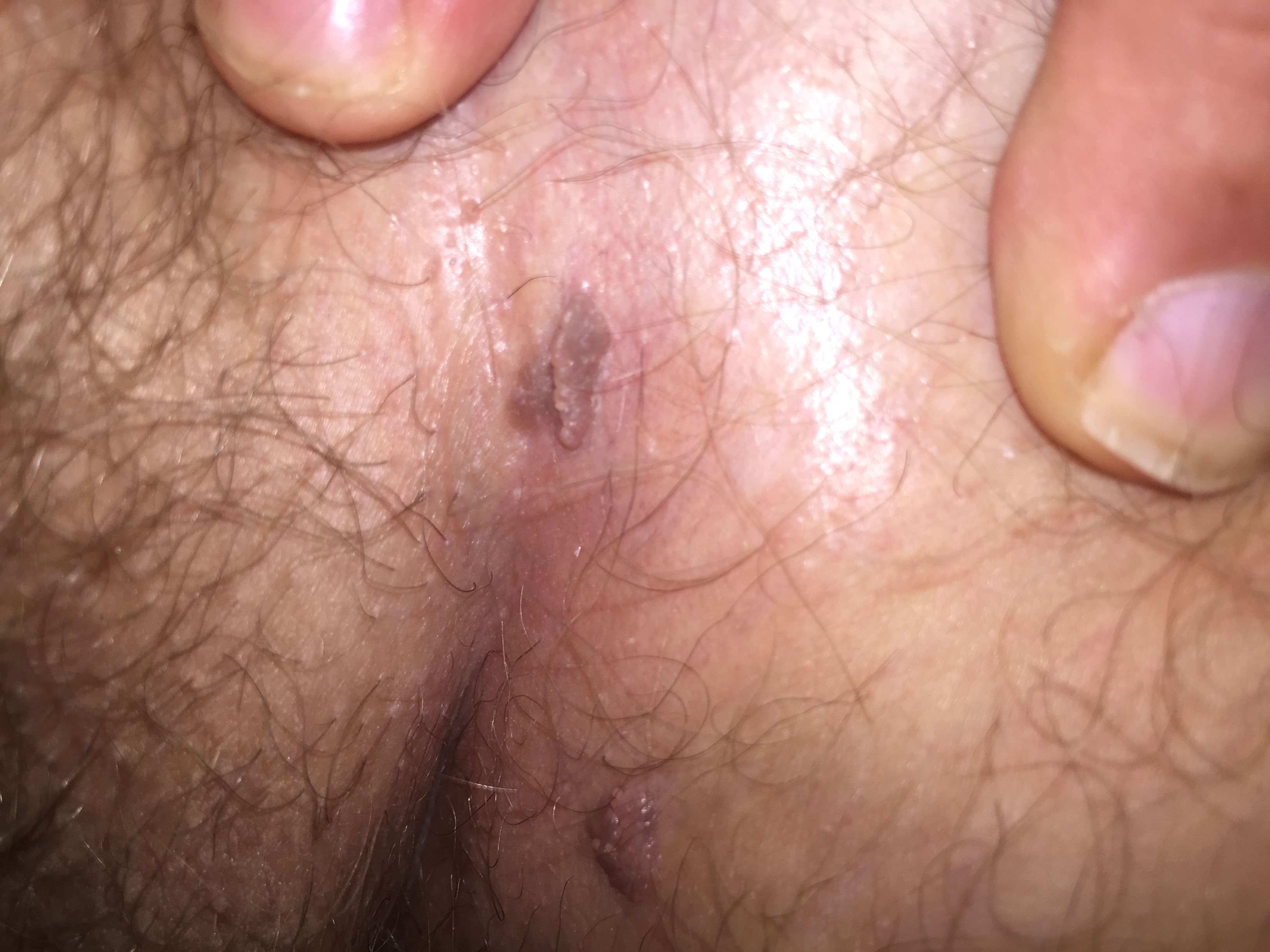 genital warts below the scrotum