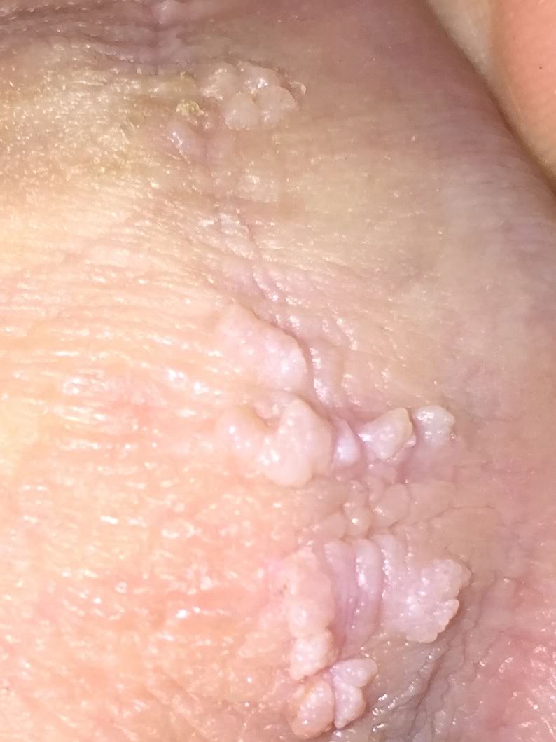 skin colored genital warts
