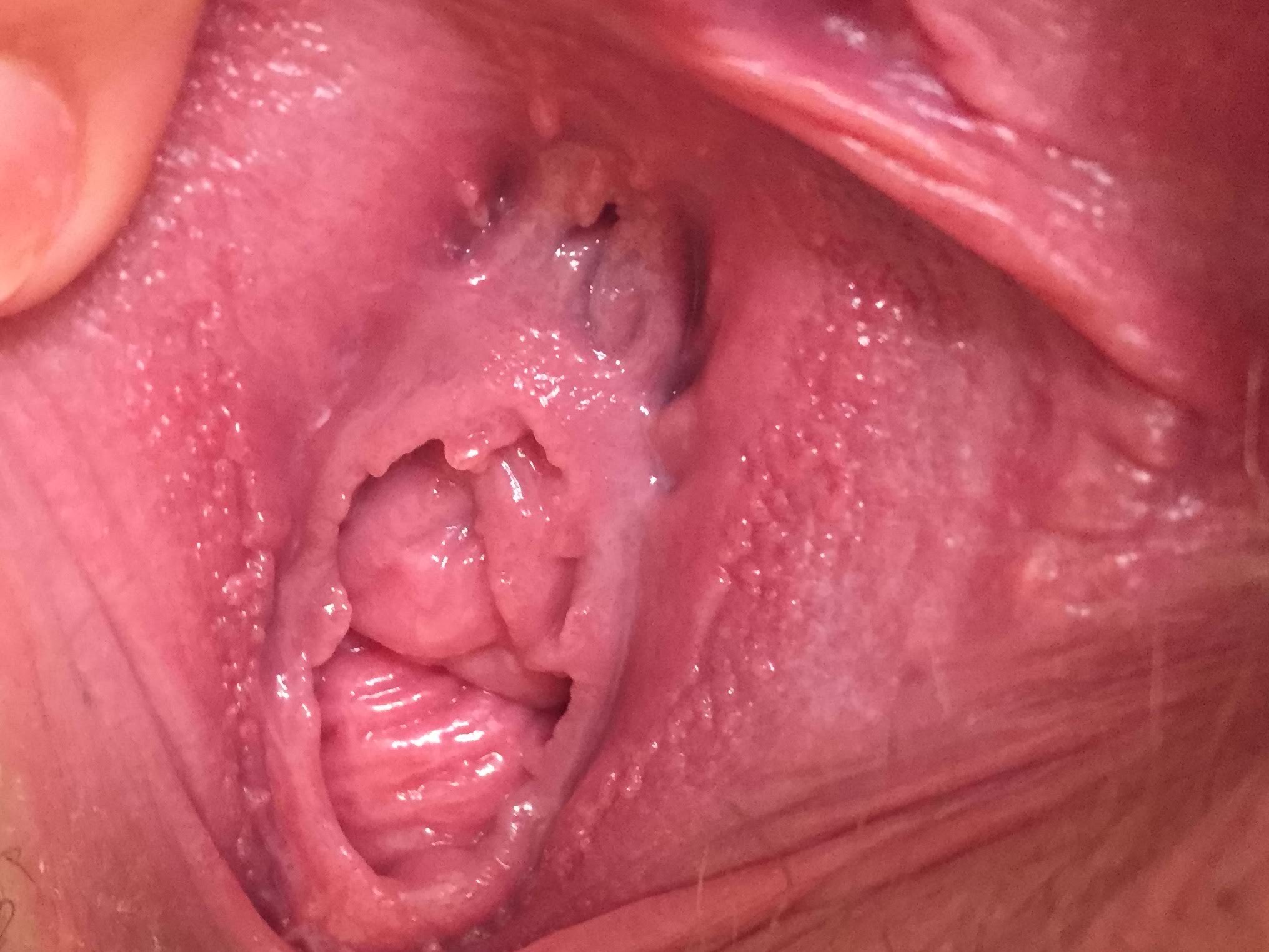 genital warts inside a woman