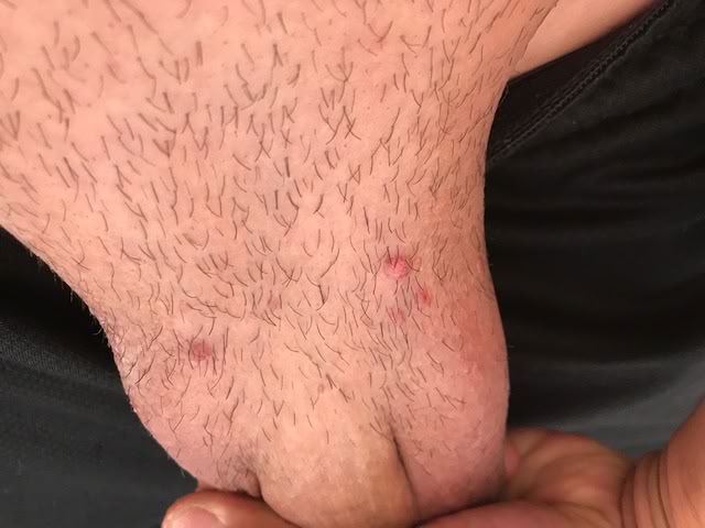 red bumps genital warts in the pubic region