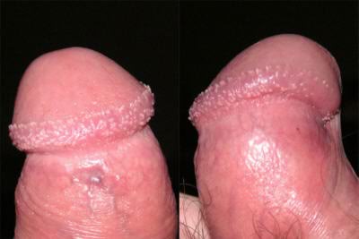 pearly penile papules