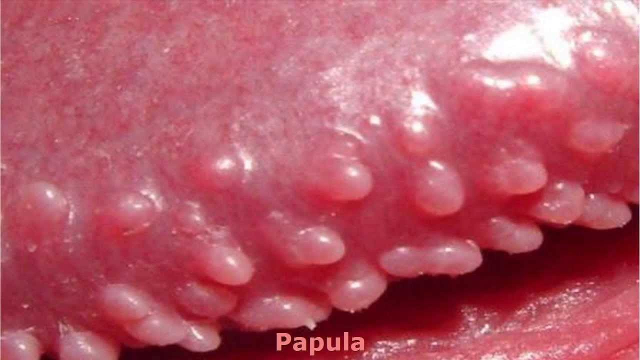 penile papules close up